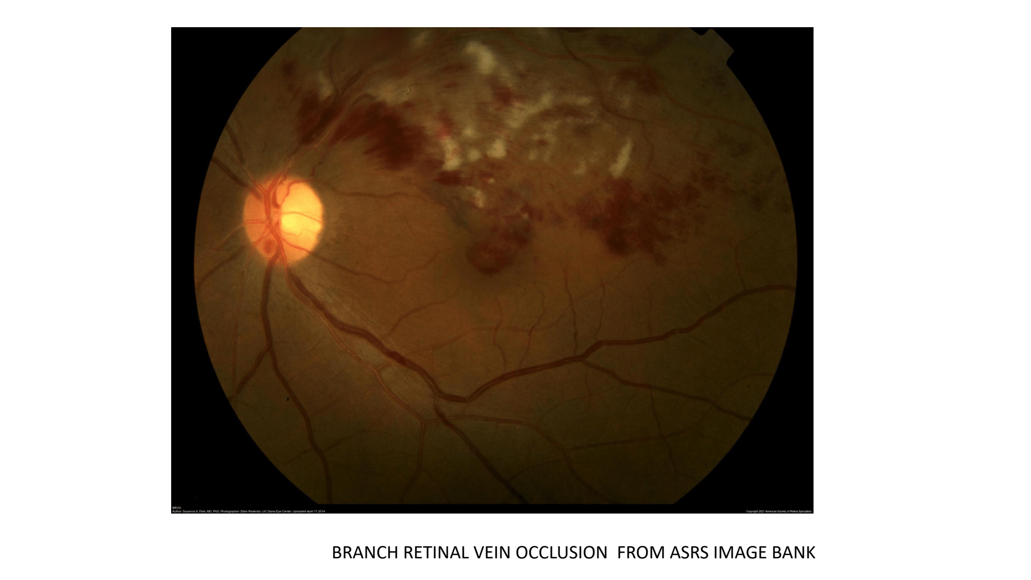 Retinal Venous Occlusive Disease